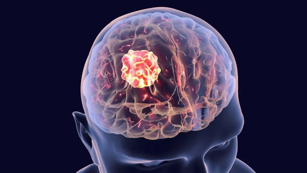 Conoce el tiempo de vida de una persona con tumor cerebral
