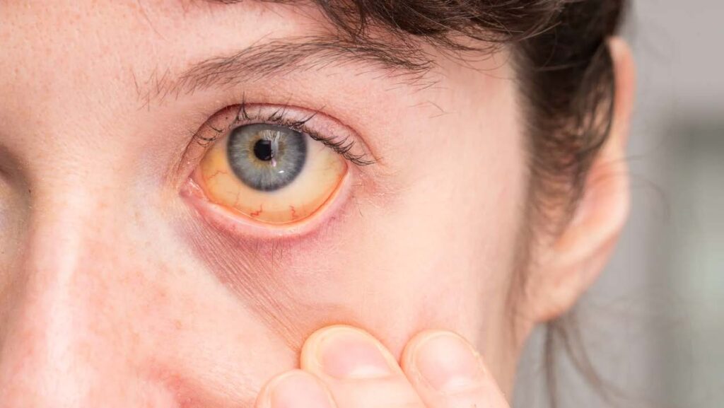 Tumor en el ojo_ tipos, causas y síntomas