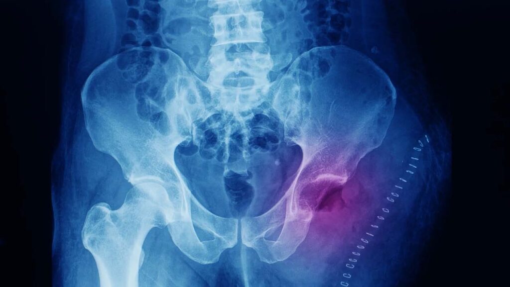 Osteosarcoma y condrosarcoma_ diferencias y opciones de tratamieto