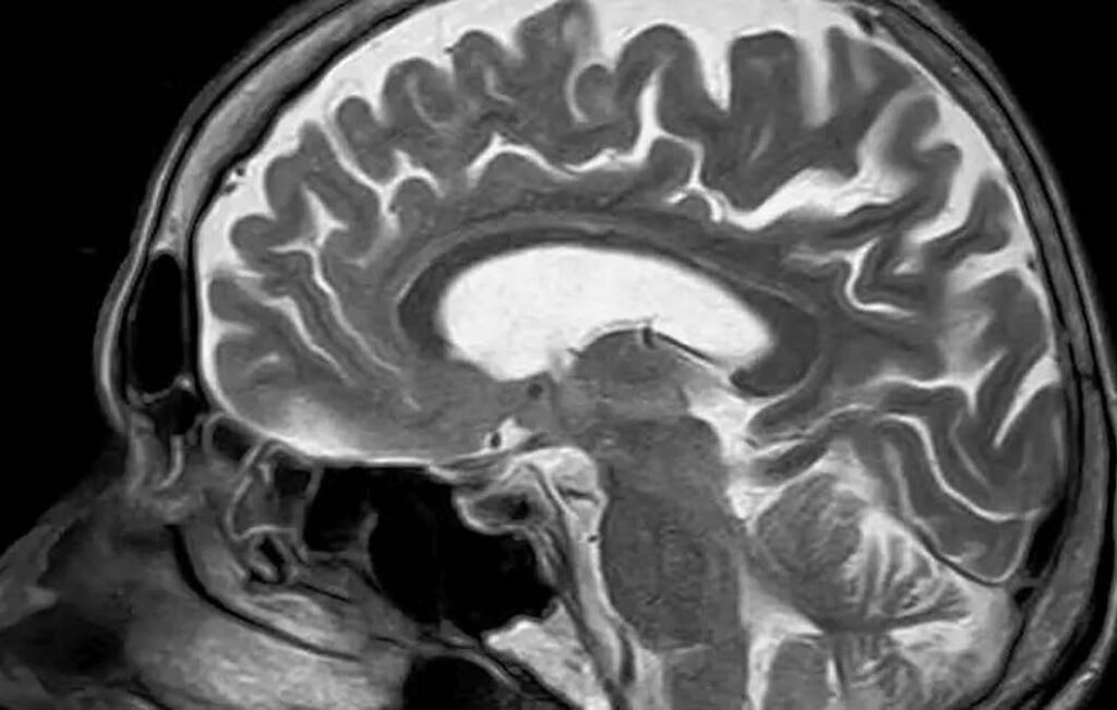 Comprendiendo y tratando el adenoma hipofisario lo que necesitas saber