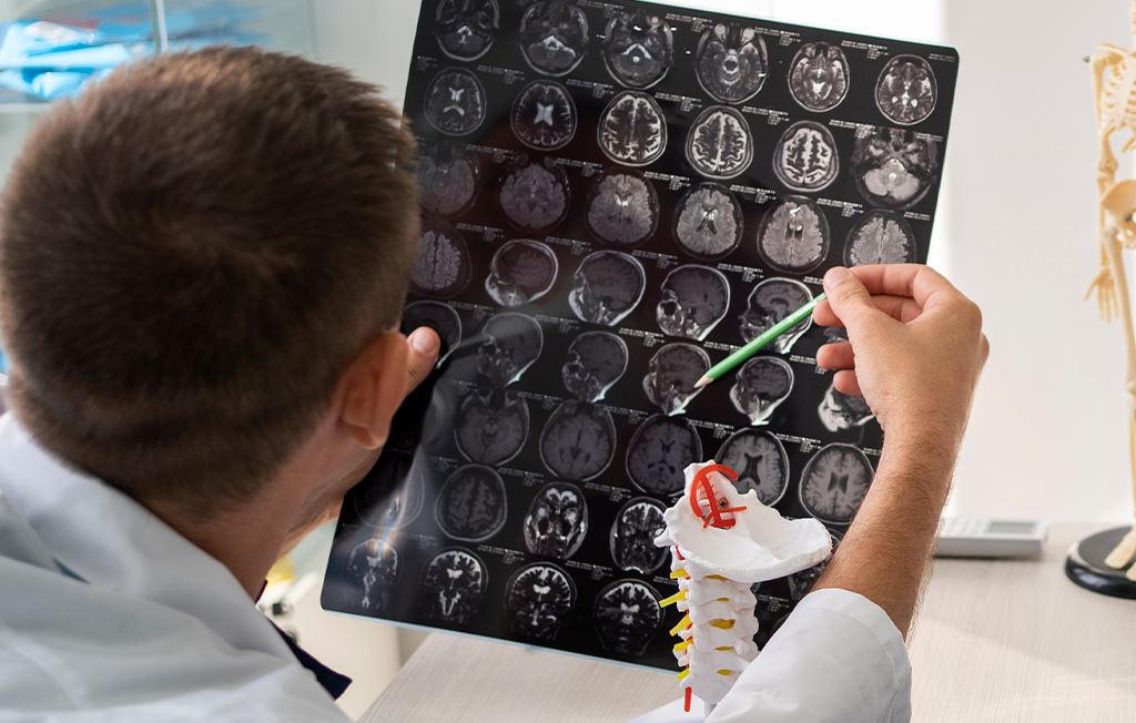 Glioma recurrente: La eficacia de Gamma Knife en la lucha contra el cáncer cerebral