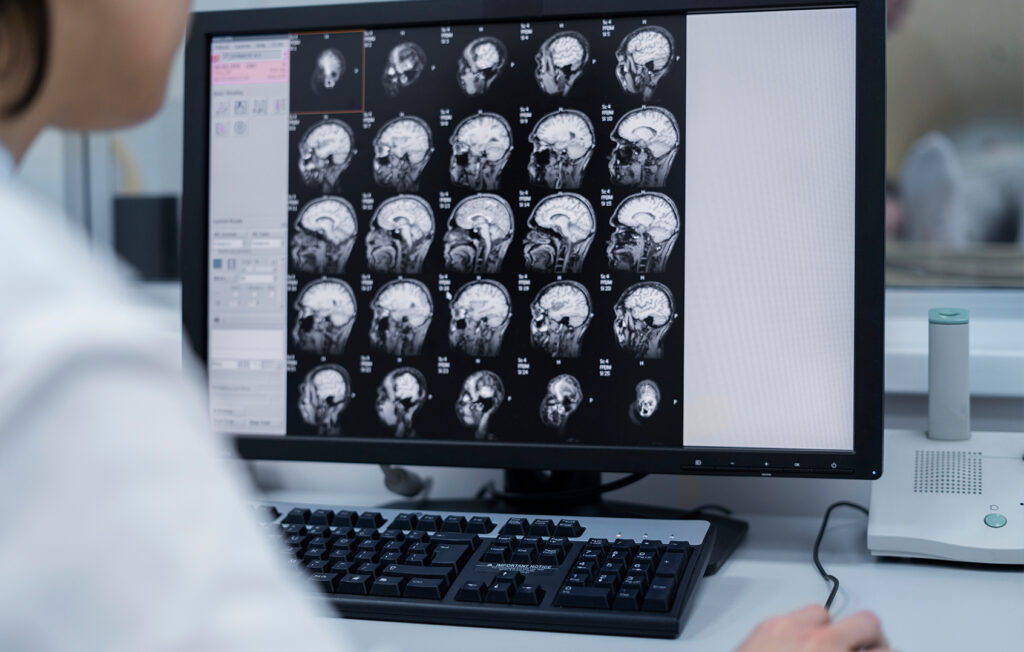 Los meningiomas: ¿qué son y cómo se previenen?