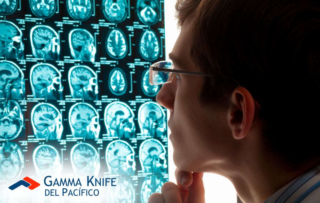 Avances en el tratamiento de meningiomas