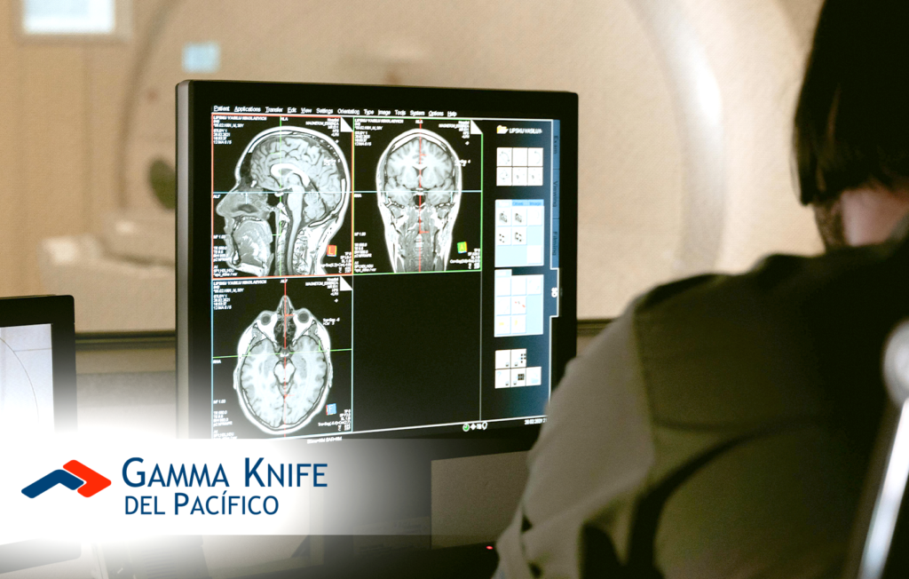 Glioblastoma: Conoce sobre el tumor cerebral agresivo