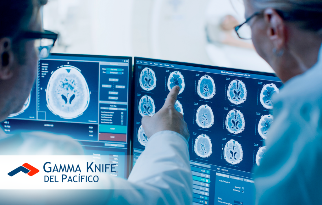 Meningiomas: Causas, Síntomas y Tratamientos