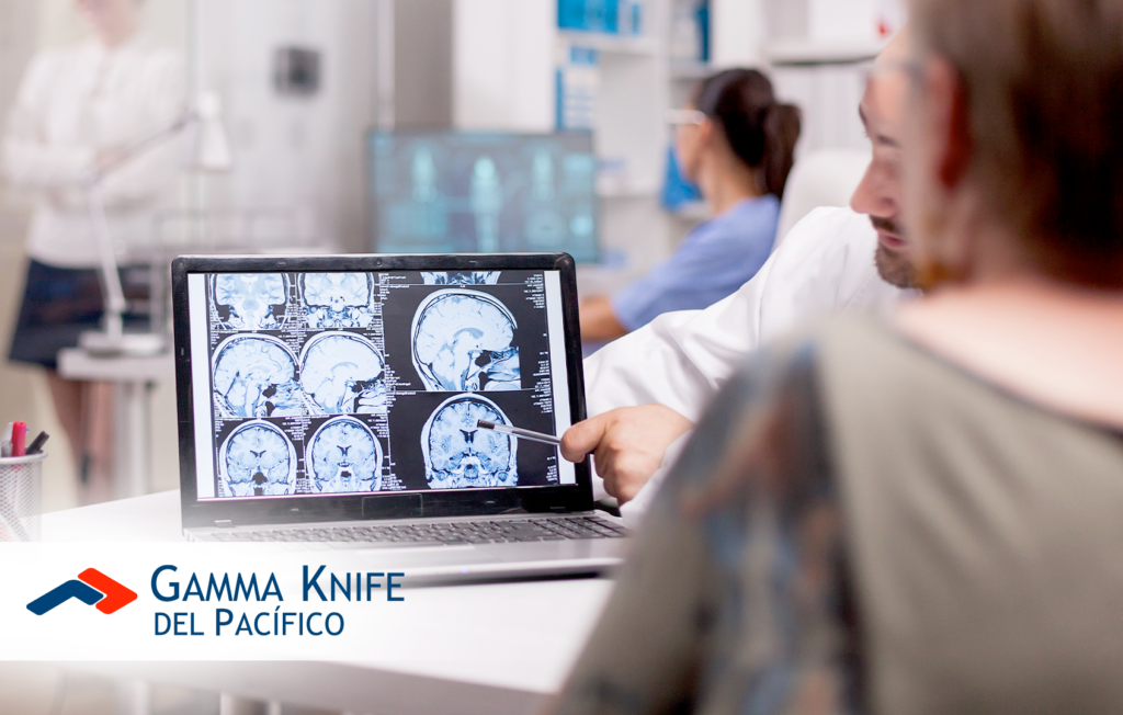 Tratamiento de Meningiomas con Gamma Knife