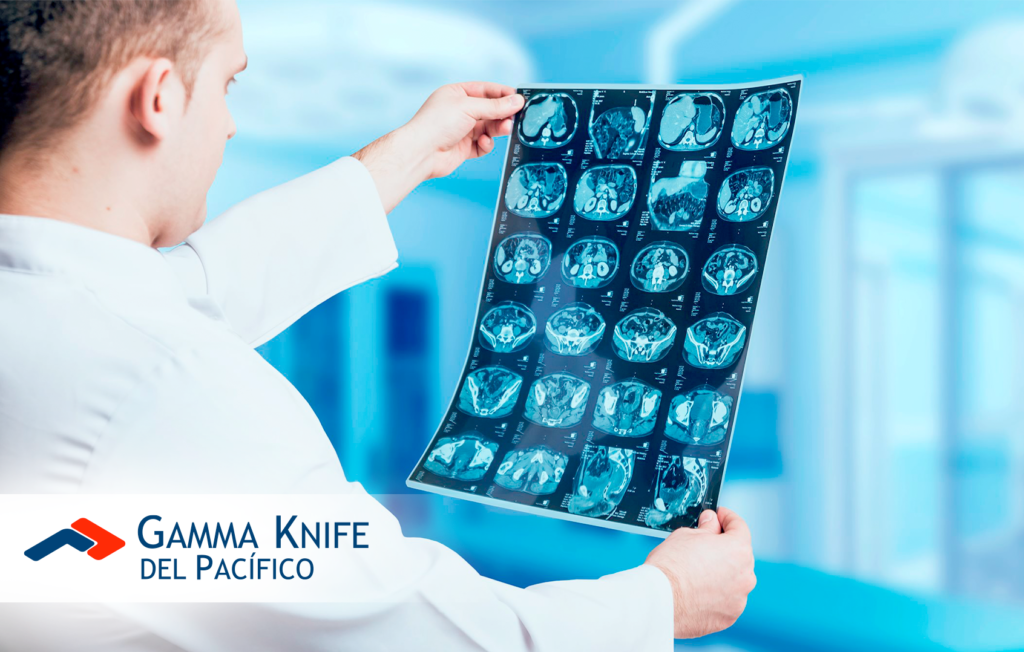 Meduloblastoma: Esperanza de victoria con Gamma Knife
