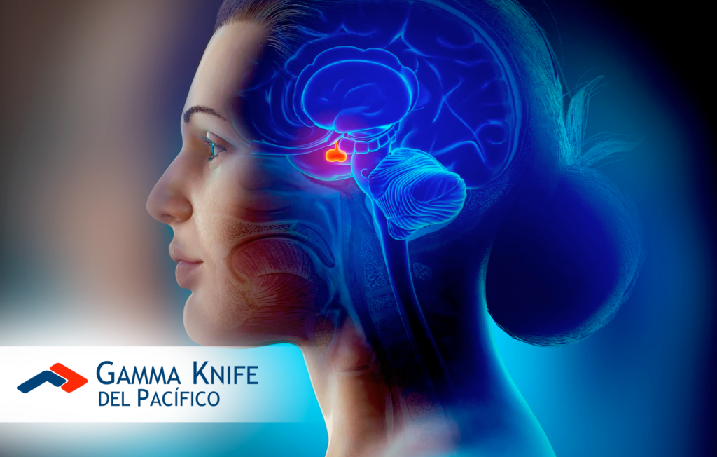 Adenomas de Hipófisis: Causas, Síntomas y Tratamientos