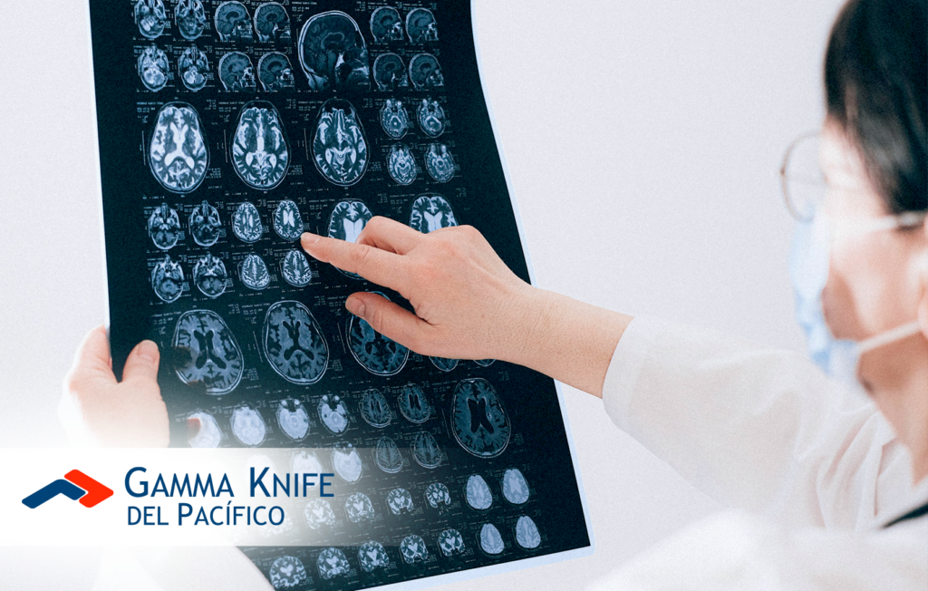 Influencia de los factores genéticos en la propagación de metástasis cerebrales