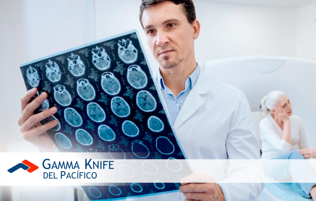 Metástasis Cerebral: Guía Completa sobre Causas, Síntomas y Tratamientos Modernos