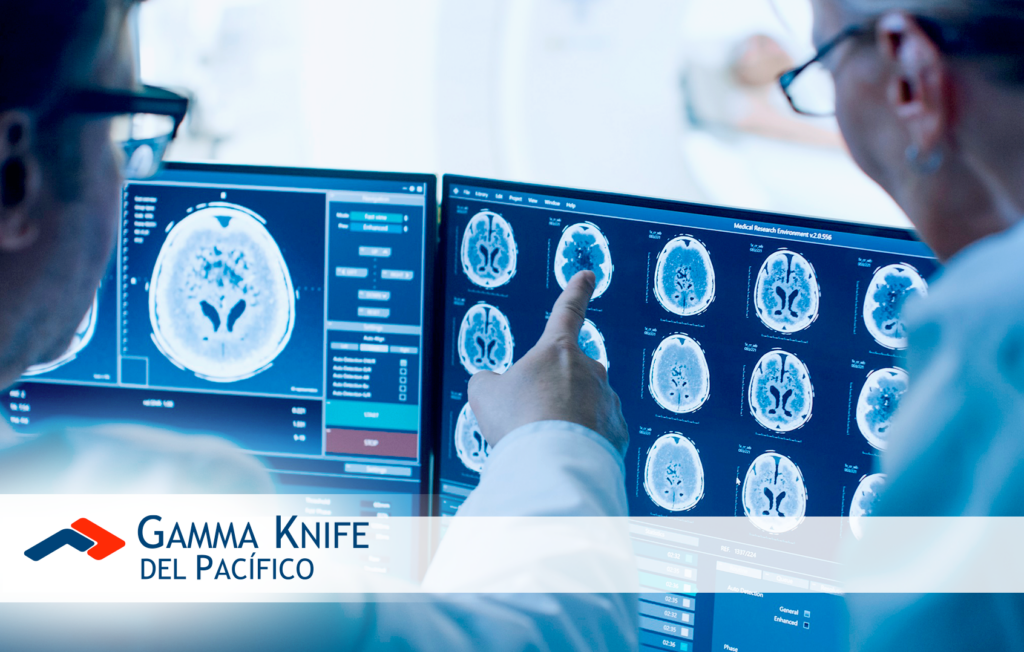Metástasis cerebral: tratamiento avanzado con Gamma Knife Esprit
